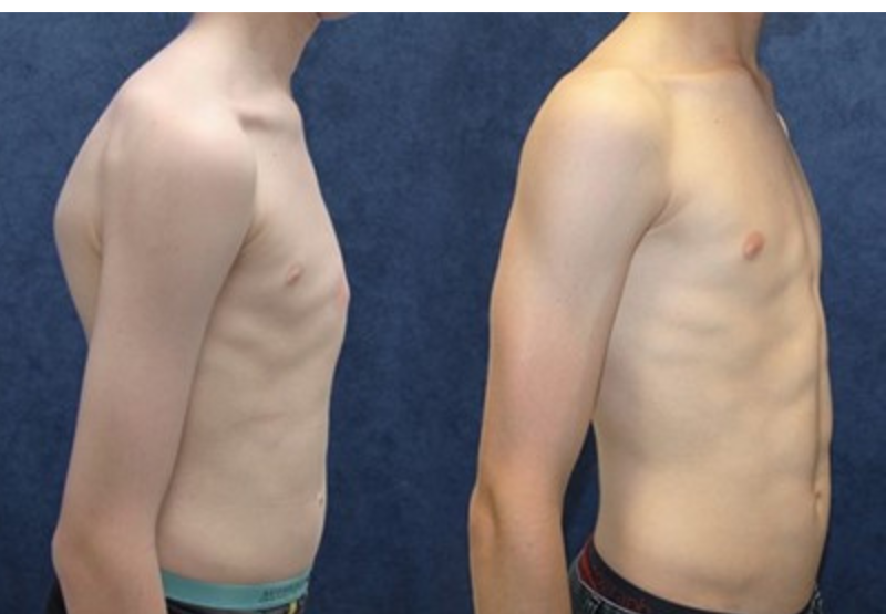 What is Pectus Carinatum?